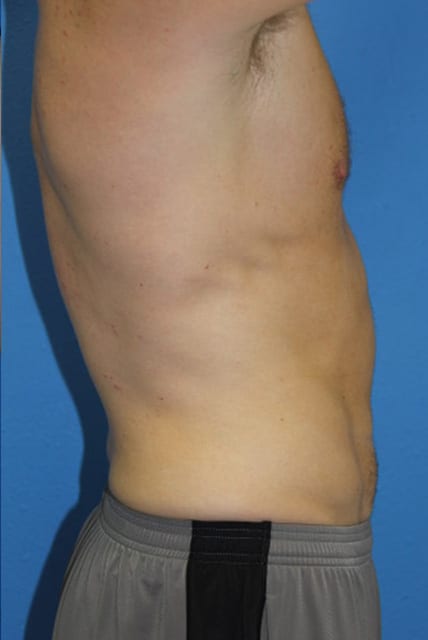 Case--9106 | After Male Liposuction 4