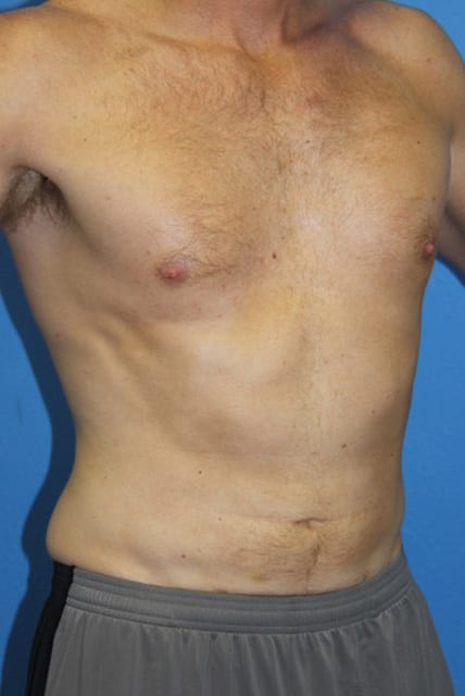 Case--9106 | After Male Liposuction 3