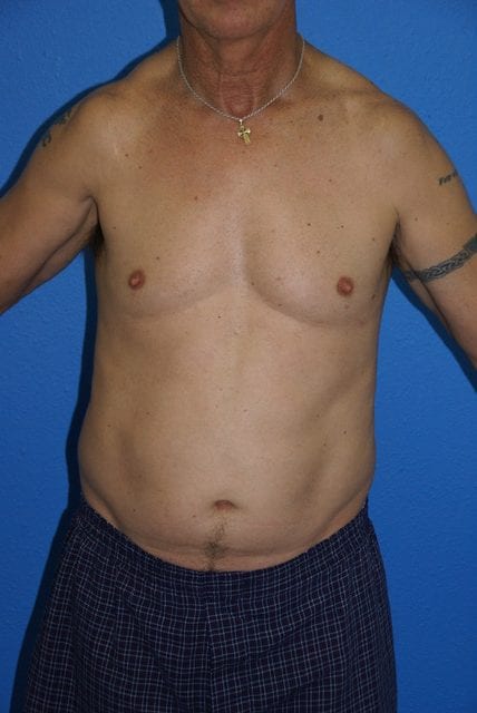 Case--4051 | Before Male Liposuction 1