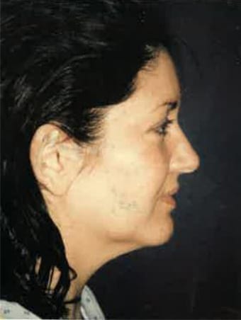Case--8870 | Before Neck Lift 1