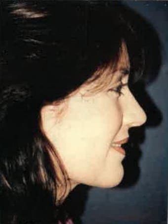 Case--8870 | After Neck Lift 1