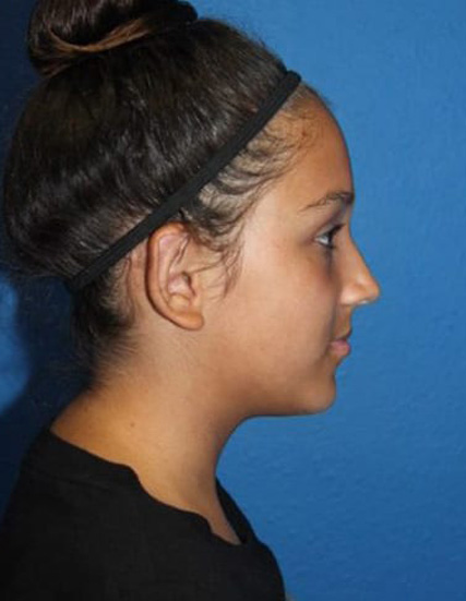 Case--8859 | After Ear Surgery / Otoplasty 2
