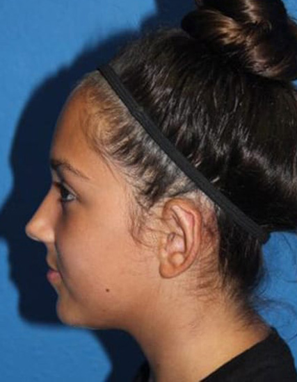 Case--8859 | After Ear Surgery / Otoplasty 4