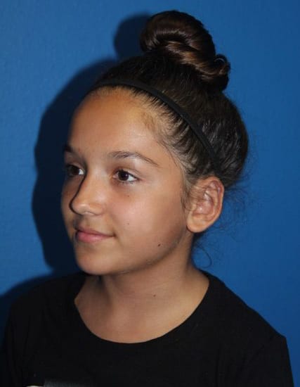 Case--8859 | After Ear Surgery / Otoplasty 5