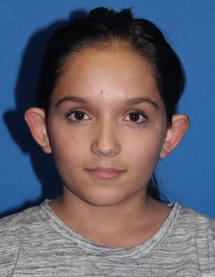 Case--8859 | Before Ear Surgery / Otoplasty 1