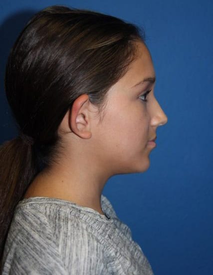 Case--8859 | Before Ear Surgery / Otoplasty 2