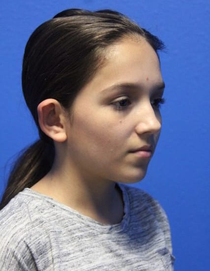 Case--8859 | Before Ear Surgery / Otoplasty 3