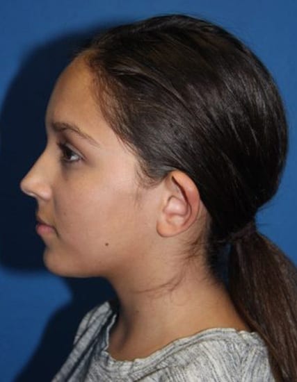 Case--8859 | Before Ear Surgery / Otoplasty 4