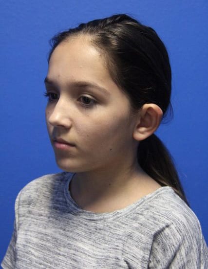 Case--8859 | Before Ear Surgery / Otoplasty 5
