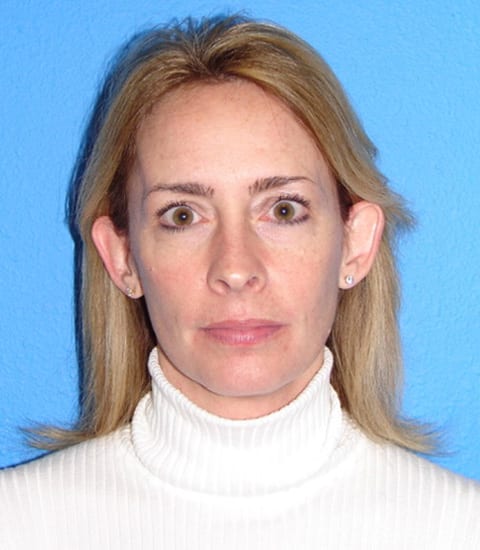 Case--7094 | Before Ear Surgery / Otoplasty 1