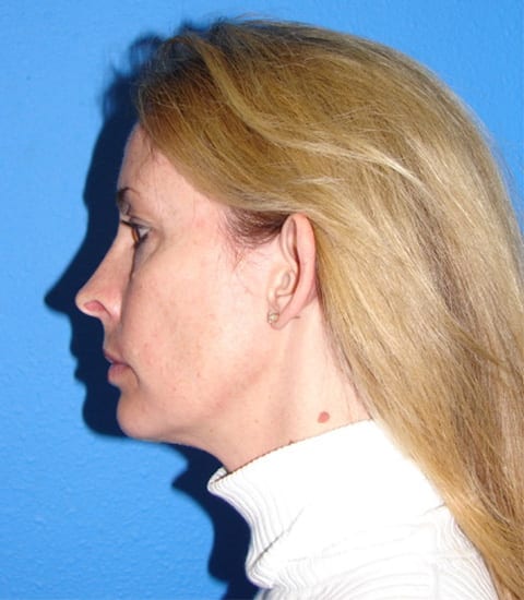Case--7094 | Before Ear Surgery / Otoplasty 3