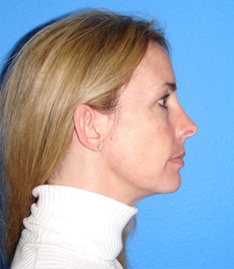 Case--7094 | After Ear Surgery / Otoplasty 2