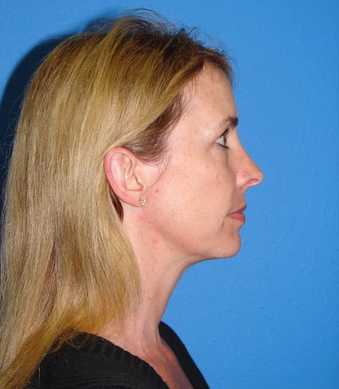 Case--7094 | Before Ear Surgery / Otoplasty 2