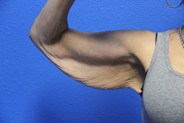Case--8179 | Before Arm Lift / Brachioplasty 2