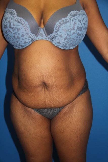 Case--8592 | Before Tummy Tuck 1