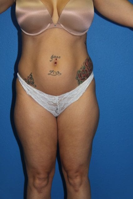 Case--5624 | Before Brazilian Butt Lift 2