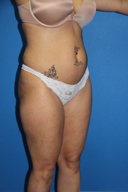 Case--5624 | Before Brazilian Butt Lift 3
