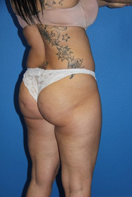 Case--5624 | Before Brazilian Butt Lift 7