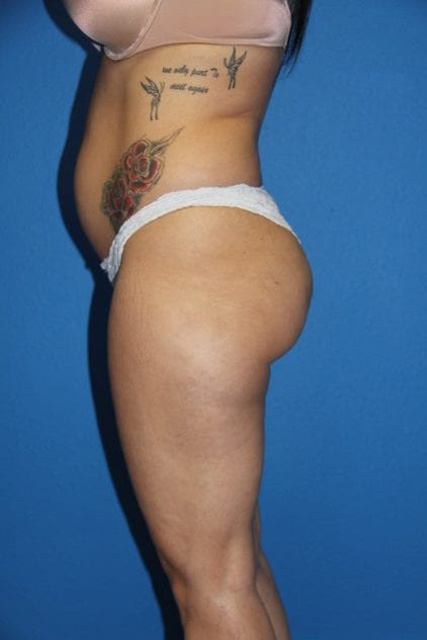Case--5624 | Before Brazilian Butt Lift 4