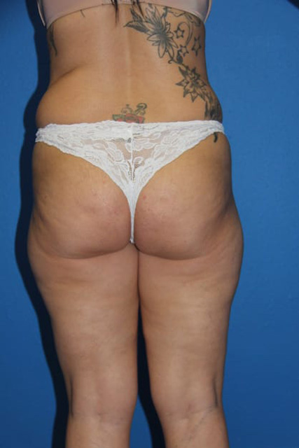Case--5624 | Before Brazilian Butt Lift 1