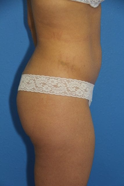 Case--2415 | Before Brazilian Butt Lift 3