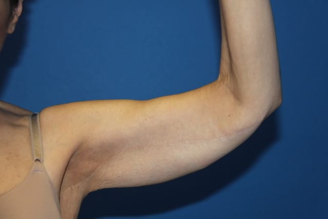 Case--8179 | After Arm Lift / Brachioplasty 1
