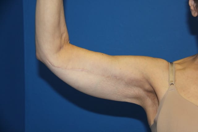 Case--8179 | After Arm Lift / Brachioplasty 2