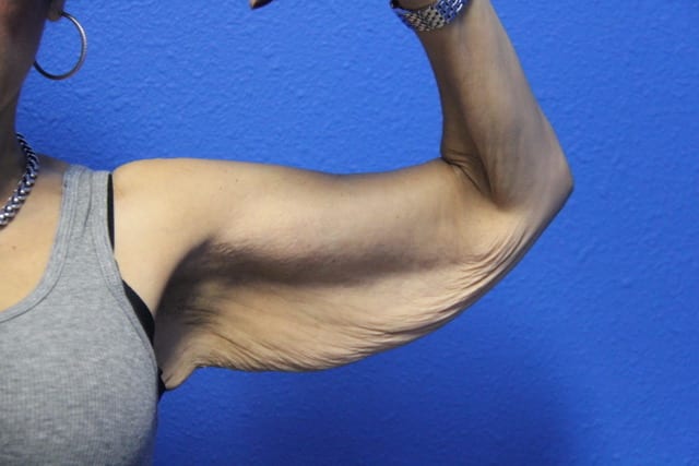Case--8179 | Before Arm Lift / Brachioplasty 1