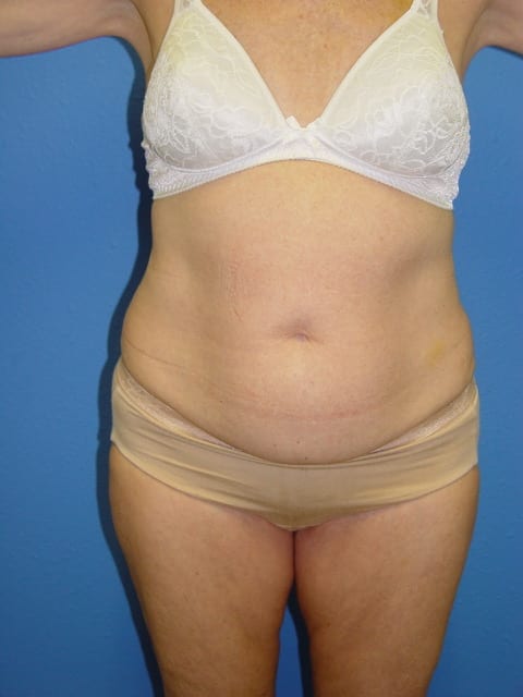 PT2-MM-Before