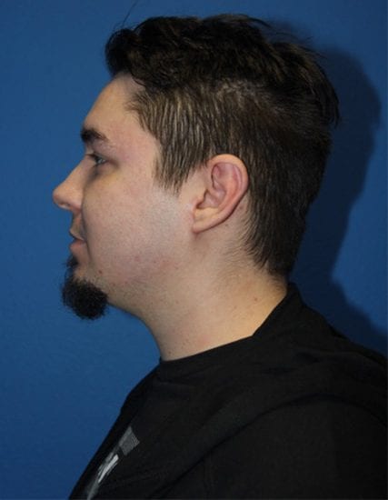 Case--5424 | After Ear Surgery / Otoplasty 2