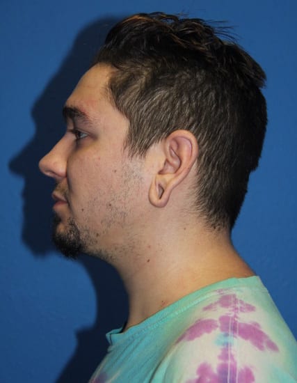Case--5424 | Before Ear Surgery / Otoplasty 2