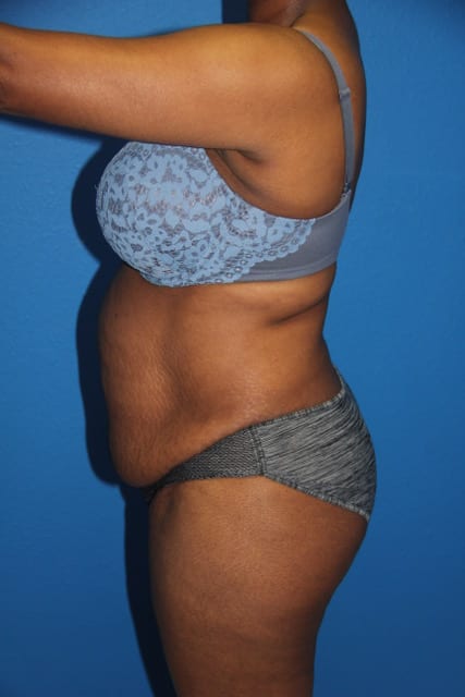 Case--8592 | Before Tummy Tuck 2