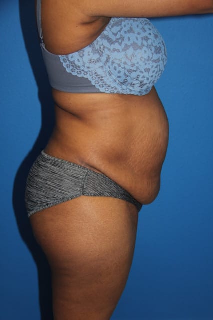 Case--8592 | Before Tummy Tuck 3
