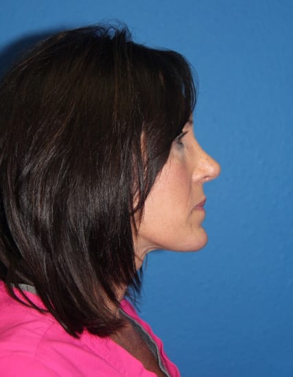 Case--4451 | After Nose Surgery / Rhinoplasty 2