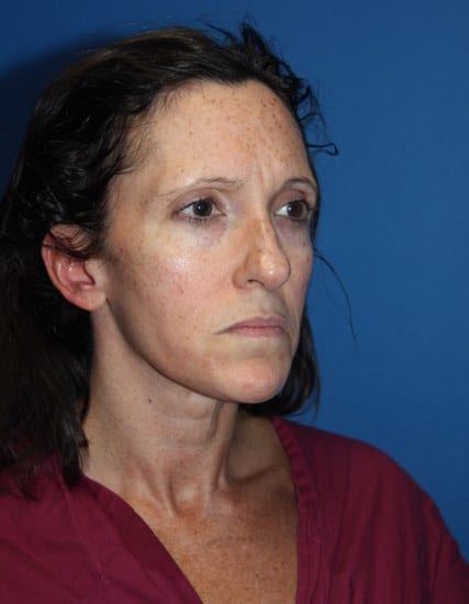 Case--4451 | Before Nose Surgery / Rhinoplasty 1