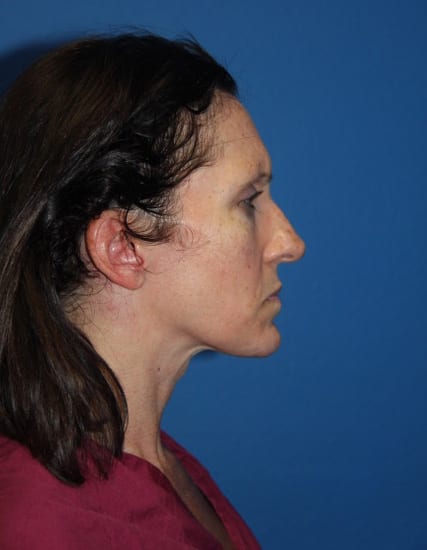 Case--4451 | Before Nose Surgery / Rhinoplasty 2