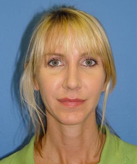 Case--7722 | After Nose Surgery / Rhinoplasty 1