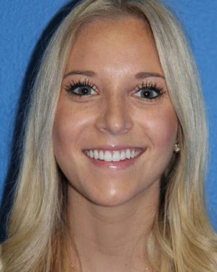 Case--2897 | After Nose Surgery / Rhinoplasty 1