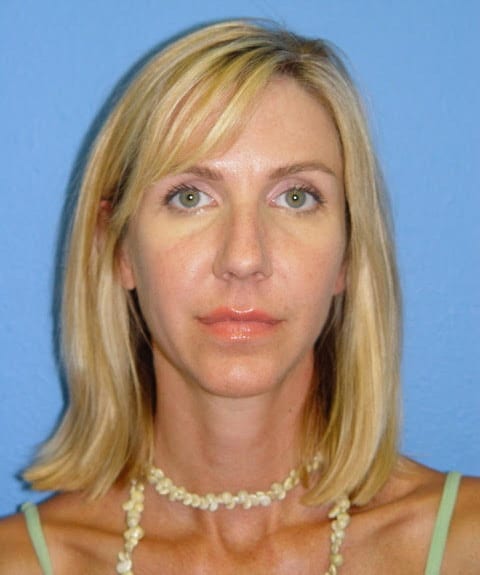 Case--7722 | Before Nose Surgery / Rhinoplasty 1
