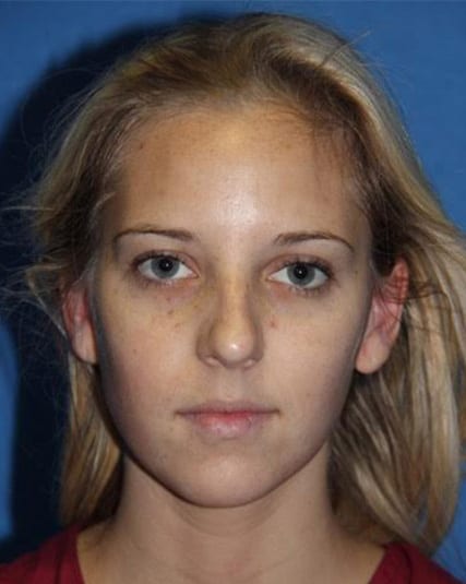 Case--2897 | Before Nose Surgery / Rhinoplasty 1