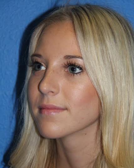 Case--2897 | After Nose Surgery / Rhinoplasty 2