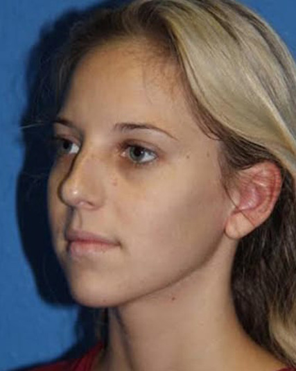 Case--2897 | Before Nose Surgery / Rhinoplasty 2