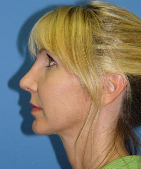 Case--7722 | After Nose Surgery / Rhinoplasty 2
