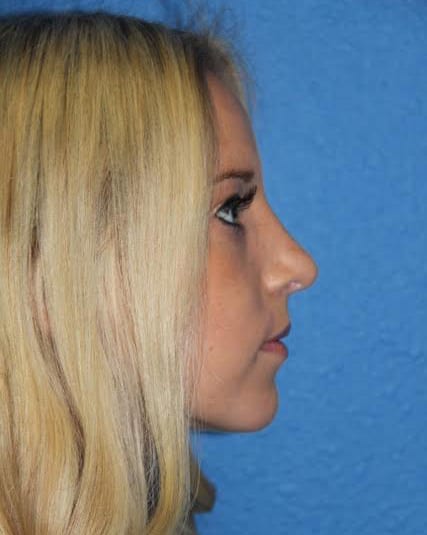 Case--2897 | After Nose Surgery / Rhinoplasty 4