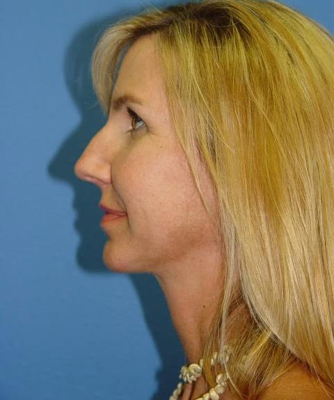 Case--7722 | Before Nose Surgery / Rhinoplasty 2