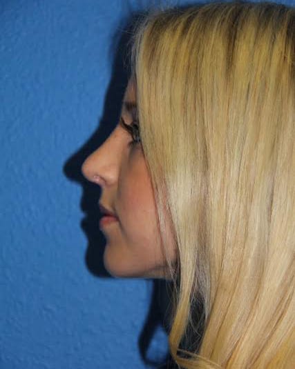 Case--2897 | After Nose Surgery / Rhinoplasty 3