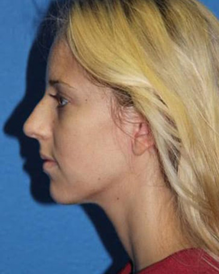 Case--2897 | Before Nose Surgery / Rhinoplasty 3