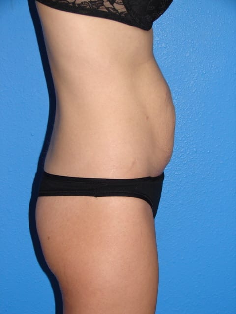 Case--8406 | Before Tummy Tuck 2