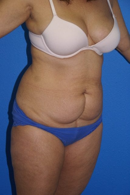 Case--8419 | Before Tummy Tuck 2