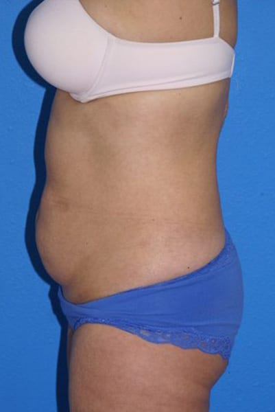 Case--8419 | Before Tummy Tuck 3